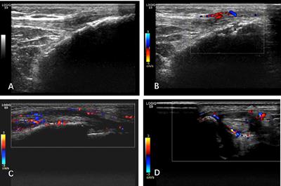 Improved diagnostic performance of CASPAR criteria with integration of ultrasound